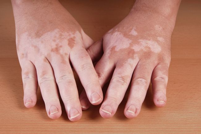 vitiligo võib paraneda