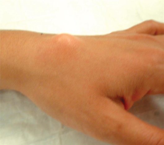 Ranniku randme ganglioni tsüst (allikas: American Society for Hand)