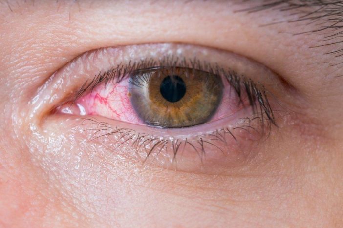 allergiline punaste silmade konjunktiviit