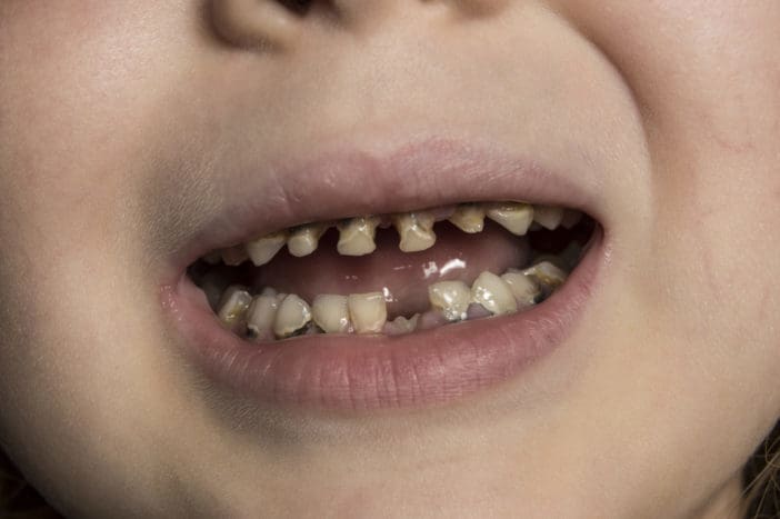 beebipudeli hammaste lagunemine laste hammaste lagunemiseks