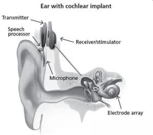 cochlear implantaadi seade