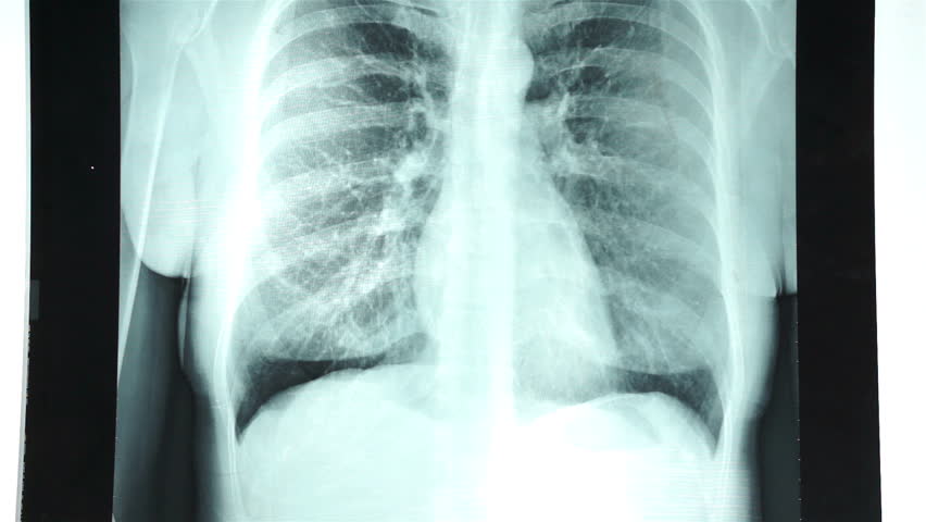 rindkere röntgen