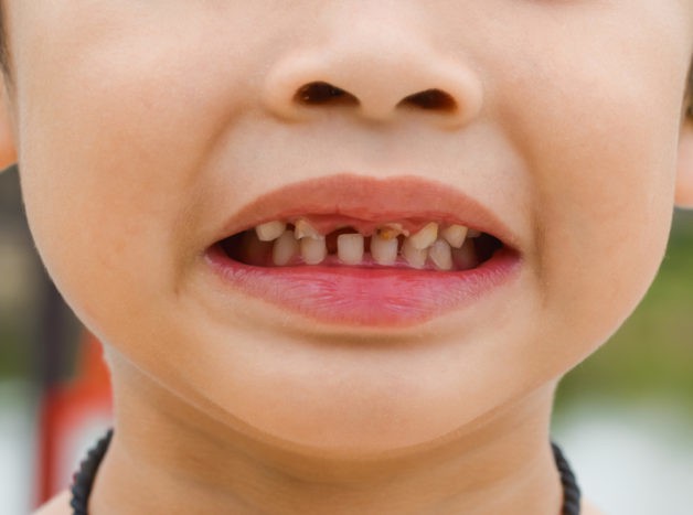 laste hammaste kahjustamine